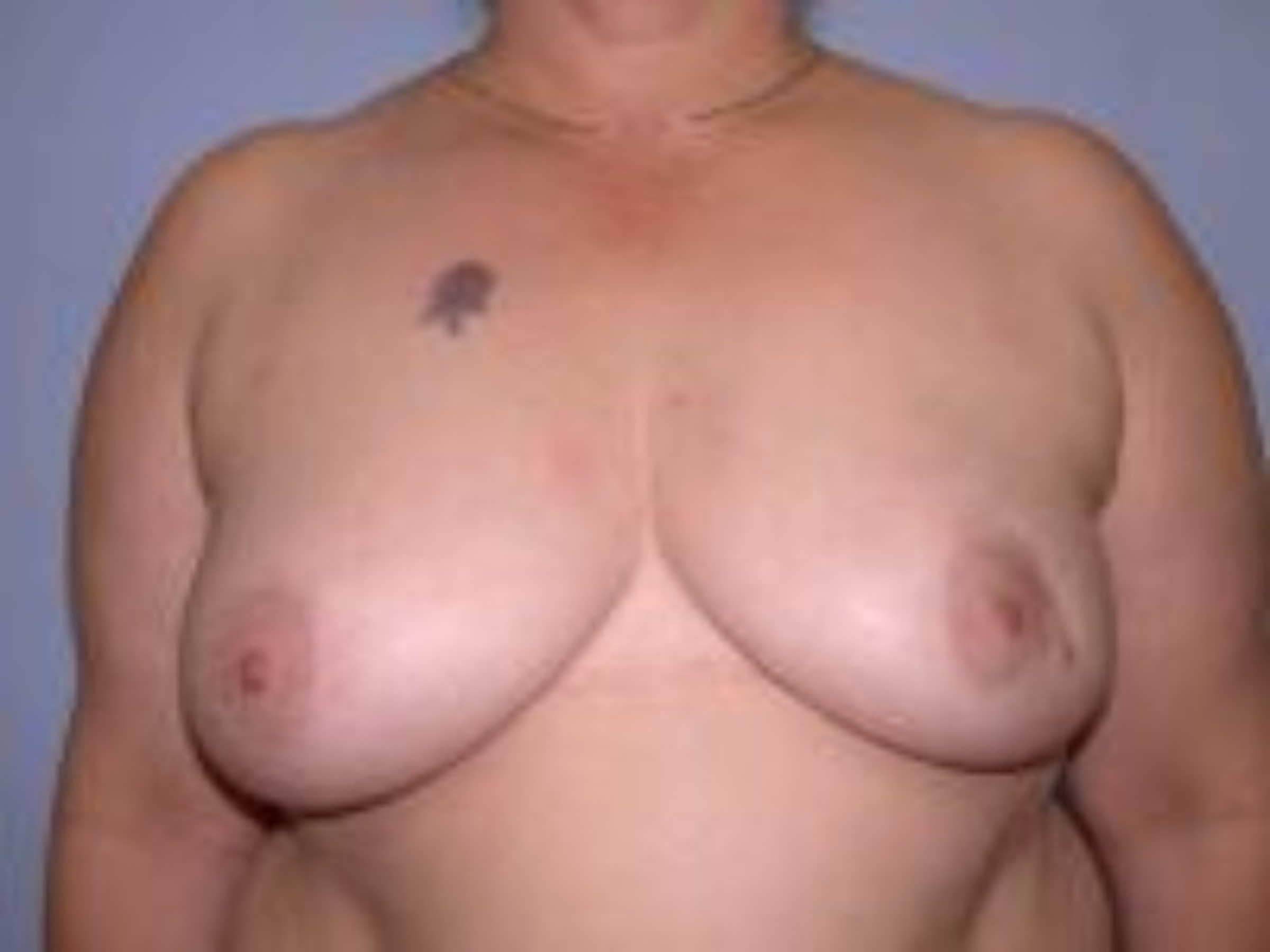 Two Stage Breast Reconstruction