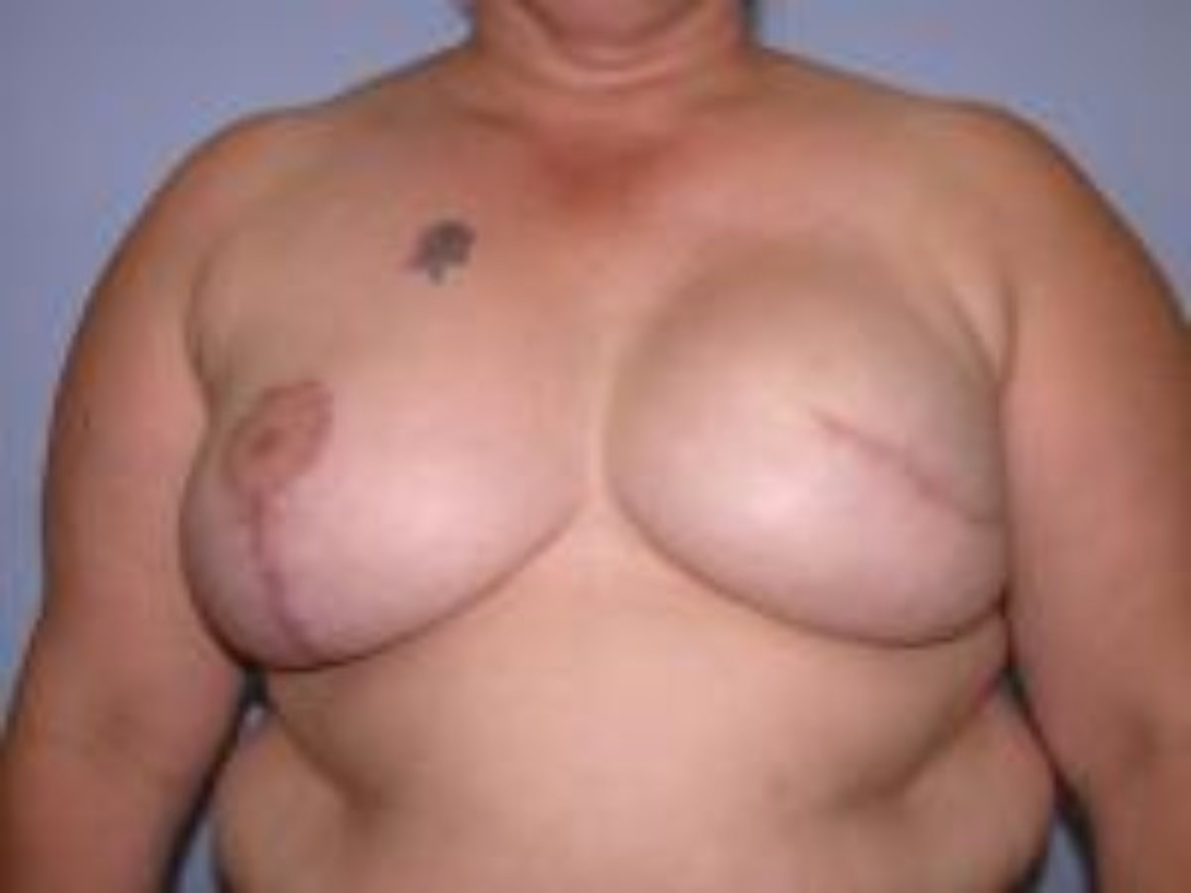 Two Stage Breast Reconstruction